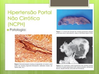 Hipertensão Portal
Não Cirrótica
(NCPH)
 Patologia:
 