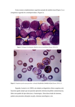 Como exames complementares sugerimos punção de medula óssea (Figura 1) e a
citoquímica sugerida foi a mieloperoxidase (Figura 2).

Figura 1. Esfregaço de mielograma. Bastão de Auer em mieloblasto (Naoum, 2010) (15).

Figura 2. Citoquímica positiva para peroxidase: coloração de grânulos e bastão de Que (Naoum, 2010) (15).

Segundo, Lorenzi et al. (2003), em relação ao diagnóstico clínico suspeita-se de
leucemia aguda sempre que um paciente apresenta sintomas de palidez cutaneomucosa,
febre com quadro de tipo infeccioso e hemorragias. Alem dessa tríade de sintomas,
podem estar presentes alterações na pele, sintomas neurológicos e etc.

 
