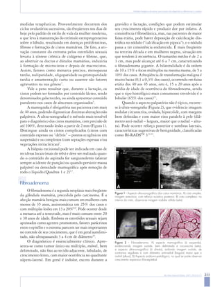 213
Rev Bras Ginecol Obstet. 2007; 29(4):211-9
Nódulos benignos da mama: uma revisão dos diagnósticos diferenciais e conduta
medidas terapêuticas. Provavelmente decorrem dos
ciclos ovulatórios sucessivos, tão freqüentes nos dias de
hoje pelo padrão de estilo de vida da mulher moderna,
o que leva à manutenção do estímulo estroprogestativo
sobre o lóbulo, resultando em doenças proliferativas,
fibrose e formação de cistos mamários. De fato, a ati-
vação constante do estroma pelos esteróides sexuais
levaria à síntese crônica de colágeno e fibrose, que,
ao obstruir os ductos e dútulos mamários, induziria
à formação de microcistos e depois de macrocistos.
Assim, fatores como menarca precoce, menopausa
tardia, nuliparidade, oligoparidade ou primiparidade
tardia e amamentação curta ou ausente são fatores
agravantes na sua gênese7
.
Vale a pena ressaltar que, durante a lactação, os
cistos podem ser formados por conteúdo lácteo, sendo
denominados galactoceles, ou ainda apresentar conteúdo
purulento nos casos de abscessos organizados5
.
A mamografia é obrigatória nas pacientes com mais
de 40 anos, podendo dignosticar distintas alterações não
palpáveis. A ultra-sonografia é o método mais sensível
para o diagnóstico dos cistos mamários, com precisão de
até 100%, detectando lesões a partir de 2 mm (Figura 1).
Distingue ainda os cistos complicados (cistos com
conteúdo espesso ou “debris” – pontos ecogênicos em
suspensão) e os complexos (com septações espessas e/ou
vegetações intracísticas)7
.
A biópsia excisional pode ser indicada em caso de
recidivas locais (mais de três) e deve ser realizada quan-
do o conteúdo do aspirado for sanguinolento (afastar
sempre acidente de punção) ou quando persistir massa
palpável ou densidade mamográfica após remoção de
todo o líquido (Quadros 1 e 2)5,7
.
Fibroadenoma
O fibroadenoma é a segunda neoplasia mais freqüente
da glândula mamária, precedida pelo carcinoma. É a
afecção mamária benigna mais comum em mulheres com
menos de 35 anos, assintomática em 25% dos casos e
com múltiplas lesões em 13 a 20%8,9
. Pode ocorrer desde
a menarca até a senectude, mas é mais comum entre 20
e 30 anos de idade. Embora os esteróides sexuais sejam
apontados como agentes promotores, fatores parácrinos
entre o epitélio e o estroma parecem ser mais importantes
no controle de seu crescimento, que é em geral autolimi-
tado, não ultrapassando 3 a 4 cm de diâmetro10
.
O diagnóstico é essencialmente clínico. Apre-
senta-se como tumor único ou múltiplo, móvel, bem
delimitado, não fixo ao tecido adjacente, lobulado, de
crescimento lento, com maior ocorrência no quadrante
súpero-lateral. Em geral é indolor, exceto durante a
gravidez e lactação, condições que podem estimular
seu crescimento rápido e produzir dor por infarto. A
consistência é fibroelástica, mas, nas pacientes de maior
faixa etária, pode haver deposição de calcificação dis-
trófica no nódulo (“calcificação em pipoca”), e o nódulo
passa a ter consistência endurecida. É mais freqüente
na terceira década e em mulheres negras, situação em
que tendem à recorrência. O tamanho médio é de 2 a
3 cm, mas pode alcançar até 6 a 7 cm, caracterizando
o fibroadenoma gigante. A bilateralidade é da ordem
de 10 a 15% e focos múltiplos na mesma mama, de 5 a
10% dos casos. A freqüência de transformação maligna é
muito baixa (0,1 a 0,3% dos casos), ocorrendo em faixa
etária dos 40 aos 45 anos, isto é, 15 a 20 anos após a
média de idade de ocorrência do fibroadenoma, sendo
que o tipo histológico mais comumente envolvido é o
lobular (65% dos casos)11
.
Quando o aspecto palpatório não é típico, recorre-
se à ultra-sonografia (Figura 2), que evidencia imagem
nodular circunscrita, ovalada, hipoecóide, com margens
bem definidas e com maior eixo paralelo à pele (diâ-
metro anti-radial – largura, maior que o radial – altu-
ra). Pode ocorrer reforço posterior e sombras laterais,
características sugestivas de benignidade, classificadas
como BI-RADSTM
312,13
.
Figura 1 - Aspecto ultra-sonográfico dos cistos mamários. A) cisto simples:
imagem anecóica, com reforço acústico posterior; B) cisto complexo: no
interior do cisto, observa-se imagem nodular sólida (seta).
A B
Figura 2 - Fibroadenoma. A) aspecto mamográfico (à esquerda),
evidenciando imagem ovóide, bem delimitada e circunscrita (seta),
e aspecto ultra-sonográfico (à direita), exibindo imagem ovóide, de
contornos regulares e com diâmetro anti-radial (largura) maior que o
radial (altura); B) Aspecto anátomo-patológico, no qual se pode observar
crescimento expansivo fibroepitelial.
A B
 