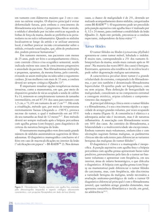 216 Rev Bras Ginecol Obstet. 2007; 29(4):211-9
Nazário ACP, Rego MF, Oliveira VM
em tumores com diâmetros maiores que 2 cm e con-
siste na exérese simples. O objetivo principal é evitar
deformidade futura, pois embora o crescimento do
fibroadenoma seja lento, é progressivo. Neste sentido,
o nódulo é abordado por incisões estéticas segundo as
linhas de força da mama, dando-se preferência às peria-
reolares ou no sulco inframamário. Quando os nódulos
localizarem-se longe da aréola e se utilizar anestesia
local, é melhor praticar incisão circumareolar sobre o
nódulo, evitando tunelizações, que, além de produzirem
dor, podem provocar hematomas23
.
Em tumores menores, nas pacientes com menos
de 25 anos, pode ser feito o acompanhamento clínico,
com controle clínico e/ou ecográfico semestral, sendo
indicada exérese nos casos de crescimento progressivo
e ansiedade da paciente. Nos fibroadenomas múltiplos
e pequenos, optamos, da mesma forma, pelo controle,
evitando-se assim múltiplas incisões sobre o tegumento
cutâneo. Já nas mulheres com mais de 35 anos, a conduta
deverá ser sempre cirúrgica (Quadro 1)23
.
É importante ressaltar opções terapêuticas menos
invasivas, como a mamotomia, em que, por meio de
dispositivo gerador de vácuo acoplado a sonda de calibre
8 a 14, removem-se completamente tumores de tamanho
intermediário, em até 87,5% dos casos para tumores com
1,5 cm, e 71,4% em tumores de até 2 cm24,25
. Há ainda
a crioablação, método que, por meio de temperaturas
extremamente baixas (chegando a -196°C), provoca
necrose do tumor, o qual é reabsorvido em até 95%
do seu tamanho ao final de 12 meses26,27
. Este método
deverá ser sempre realizado após a biópsia percutânea
com agulha grossa (core-biopsy), para diagnóstico de
certeza da natureza benigna da lesão.
O rastreamento mamográfico vem detectando grande
número de nódulos assintomáticos sugestivos de fibro-
adenomas. O diagnóstico mamográfico conclusivo só é
feito em caso de macrocalcificações no interior da lesão
(“calcificações em pipoca” – BI-RADSTM
2). Nos demais
Figura 3 - Fibroadenoma. Punção aspirativa com agulha fina orientada
pela ultra-sonografia (esquerda) e aspecto citológico arborescente
característico, com projeções fibroepiteliais em dedo de luva (direita).
agulha
casos, a chance de malignidade é de 2%, devendo ser
realizado acompanhamento destes nódulos, categorizados
como BI-RADSTM
3. O seguimento pode ser precedido
pela punção aspirativa com agulha fina e é realizado por
6, 12 e 24 meses, para confirmar a estabilidade da lesão
(Quadro 2). Após este período, preconiza-se a conduta
expectante, independente da faixa etária13,23
.
T
umor ﬁlóides
O tumor filóides ou filodes (cystosarcoma phyllodes)
apresenta-se como tumor móvel, lobulado e indolor.
É muito raro, correspondendo a 2% dos tumores fi-
broepiteliais da mama, sendo mais comum após os 40
anos2
. Na maioria das vezes (80% dos casos) é benigno.
Entretanto, apresenta alta tendência de recidiva local e
pode sofrer degeneração maligna sarcomatosa.
A característica peculiar deste tumor é a grande
celularidade do estroma, comparada à do fibroadeno-
ma, e por isto também é denominado fibroadenoma
hipercelular. O epitélio pode ser hiperplásico, com
ou sem atipias. Para definição de benignidade ou
malignidade, consideram-se no componente estromal
a contagem mitótica, atipias celulares e comprome-
timento das margens11
.
A principal diferença clínica entre o tumor filóides
e o fibroadenoma, é o seu crescimento rápido e a capa-
cidade de atingir grandes volumes, por vezes ocupando
toda a mama (Figura 4). A consistência é elástica e a
adenopatia axilar não é incomum, mas é de natureza
inflamatória. A associação com fibroadenoma ocorre
em 30% dos casos. Ao contrário do fibroadenoma, a
bilateralidade e a multicentricidade são excepcionais.
Embora tumores mais volumosos, endurecidos e com
ulcerações sugiram formas malignas, os parâmetros
clínicos não são suficientes para diferenciar as variantes
benignas das malignas do tumor filóides11
.
O diagnóstico é clínico e a mamografia é inespe-
cífica. A punção aspirativa com agulha fina e a biópsia
percutânea com agulha grossa apresentam baixo valor
preditivo, provavelmente pelo fato de o tumor ser bas-
tante volumoso e apresentar com freqüência, em seu
interior, áreas de infarto hemorrágico, o que dificulta
o diagnóstico. A biópsia com agulha grossa (core biop-
sy ou mamotomia) pode diferenciar o tumor filóides
do carcinoma, mas, com freqüência, não discrimina
a variedade benigna da maligna, sendo necessária a
avaliação anátomo-patológica de todo o tumor O
diagnóstico diferencial principal é com o fibroadenoma
juvenil, que também atinge grandes dimensões, mas
apresenta consistência fibroelástica e incide, em geral,
na adolescência16,23
.
 