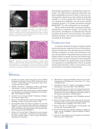 218 Rev Bras Ginecol Obstet. 2007; 29(4):211-9
Nazário ACP, Rego MF, Oliveira VM
denominado angiolipoma e condrolipoma, respectiva-
mente30
. Já o hamartoma é lesão pouco observada, com
perfil mamográfico peculiar de lesão circunscrita con-
tendo gordura. Apresenta-se como nódulo de dimensões
variadas (1 a 20 cm), amolecido e móvel. Esta afecção
tem margens bem definidas, mas não possui cápsula
verdadeira (Figura 5). É achado tipicamente benigno
(BI-RADSTM
2) e não é obrigatória sua enucleação31
.
Devem ainda ser destacados os adenomas mamários,
classificados em adenoma tubular e da lactação. São
clinicamente semelhantes aos fibroadenomas (Figura
6), porém, do ponto de vista microscópico, são tumores
epiteliais benignos com estroma normal em relação a
sua função de sustentação14
.
Considerações ﬁnais
As doenças mamárias benignas compõem grande
maioria das queixas mamárias do dia-a-dia do gineco-
logista. É importante saber distingui-las com acurácia,
evitando iatrogenias, ao indicar procedimentos cirúr-
gicos desnecessários e dispendiosos para pacientes com
nódulos sólidos à ecografia. Por meio dos métodos diag-
nósticos atuais, seja por mamografia, ultra-sonografia,
citologia ou biópsia com agulha grossa, pode-se propor
com segurança o acompanhamento clínico da grande
maioria destas afecções e indicar com precisão os casos
que deverão ser excisados cirurgicamente.
Figura 5 - Hamartoma. A) aspecto mamográfico: na incidência oblíqua,
visibiliza-se imagem radiolucente que compromete toda a mama e
rechaça o parênquima mamário superiormente (seta); B) aspecto anátomo-
patológico correspondente: tecido fibroglandular, estroma fibroso e tecido
adiposo presentes em proporção variável.
A B
Figura 6 - Adenoma. A) aspecto ultra-sonográfico: imagem nodular
hipoecóica, bem delimitada, indistinguível do fibroadenoma; B) Aspecto
anátomo-patológico correspondente: observa-se proliferação epitelial
proeminente, com estruturas glandulares muito próximas umas das outras
e apresentando pequena quantidade de secreção no lúmen glandular.
A B
B
Referências
Ministério da Saúde. Instituto Nacional do Câncer (INCA)
[homepage da Internet]. Estimativa 2006. Incidência de câncer
no Brasil. [citado 2007 Jan 12]. Disponível em: http://www.
inca.gov.br/estimativa/2006/
Boff RA, Wisintainer F. Mastologia moderna: abordagem
multidisciplinar. Caxias do Sul: Mesa Redonda; 2006.
Dixon JM, Mansel RE. ABC of breast diseases: congenital problems
and aberrations of normal breast development and involution.
BMJ. 1994;309(6957):797-800.
Veronesi U, Luini A, Costa A, Andreoli C. Mastologia oncológica.
Rio de Janeiro: Medsi; 2002.
Barros AC, Silva HMS, Dias EN, Nazário ACP, Figueira Filho ASS.
Mastologia: condutas. Rio de Janeiro: Revinter; 1999.
Navarrete MA, Maier CM, Falzoni R, Quadros LG, Lima GR,
Baracat EC, et al. Assessment of the proliferative, apoptotic and
cellular renovation indices of the human mammary epithelium
during the follicular and luteal phases of the menstrual cycle.
Breast Cancer Res. 2005;7(3):R306-13.
Nazario ACP, Araújo Neto JT. Alterações funcionais benignas
da mama. In: Baracat EC, Lima GR. Guia de ginecologia.
São Paulo: Manole; 2005. p. 629-33. (Guias de Medicina
Ambulatorial e Hospitalar).
1.
2.
3.
4.
5.
6.
7.
Alle KM, Moss J, Venegas RJ, Khalkhali I, Klein SR. Conservative
management of fibroadenoma of the breast. Br J Surg.
1996;83(7):992-3.
Greenberg R, Skornick Y, Kaplan O. Management of breast
fibroadenomas. J Gen Intern Med. 1998;13(9):640-5.
Simomoto MM, Nazario AC, Gebrim LH, Simões MJ, Baracat EC,
De Lima GR. Morphometric analysis of the epithelium of mammary
fibroadenomas during the proliferative and secretory phases of
the menstrual cycle. Breast J. 1999;5(4):256-61.
Rosen PP. Rosen´s breast pathology. 2nd ed. Philadelphia: Lippincott-
Raven; 2001. p. 143-55.
Stavros AT, Thickman D, Rapp CL, Dennis MA, Parker SH, Sisney GA.
Solid breast nodules: use of sonography to distinguish between benign
and malignant lesions. Radiology. 1995;196(1):123-34.
Tabar L, Dean PB, Tot T. Teaching atlas of mammography. 2nd
ed. New York: Thieme Medical; 2001.
Rosen PP, Hoda SA. Breast pathology: diagnosis by needle core
biopsy. 2nd ed. Philadelphia: Lippincott Williams  Wilkins;
2006. p. 69-83.
Houssami N, Cheung MN, Dixon JM. Fibroadenoma of the breast.
Med J Aust. 2001;174(4):185-8.
8.
9.
10.
11.
12.
13.
14.
15.
 