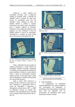 Montagem. de mod. de est. em art. semi-ajustável. Fernandes Neto , A. J. et al. Univ. Fed. Uberlândia - 2005 136
Coloca-se o ramo superior do
articulador invertido, com o respectivo
modelo já montado sobre a bancada de
trabalho (com o extremo do pino guia
incisal se estendendo para fora da
bancada). Fazer ranhuras na base do
modelo inferior e utilizar o registro
interoclusal em cêntrica para relacioná-lo
com o modelo superior já montado.
Prendê-los com 3 palitos de madeira e cera
pegajosa ou cola. Umedecer a base do
modelo inferior e fixá-lo ao articulador,
utilizando-se o mínimo de gesso pedra
para evitar possíveis distorções, fig. 46.
Fig. 46 - Fixação do modelo inferior no superior
por meio do registro cêntrico e palitos e cera
pegajosa.
Após a aplicação do gesso pedra no
modelo, posiciona-se o ramo inferior do
articulador também invertido, colocando
os côndilos em sua posição de retrusão nas
guias condilares. Fecha-se o ramo inferior
contra o gesso de consistência cremosa/
espessa, até que o pino guia toque a mesa
incisal. Mantém-se o modelo nesta posição
até a presa final do gesso.
Após a presa final remove-se o
registro de RC, retorna-se o pino guia em
zero, obtendo-se o paralelismo entre os
ramos do articulador e observa-se a
discrepância oclusal entre a RC e a MIH
na dimensão vertical de oclusão dos
modelos. Essa discrepância deve coincidir
com a situação clínica do paciente, figs 47,
48 e 49.
Fig. 47 - Colocação do gesso de fixação do modelo
inferior ao ASA.
Fig. 48 - Modelo montado ainda com o registro em
RC.
Fig. 49 - Modelo montado no ASA em RC.
Ajuste das guias do articulador
• Guias Condilares
A configuração da articulação
temporomandibular tem grande influência
nos movimentos da mandíbula. A
morfologia oclusal de qualquer restauração
deve estar em harmonia com os
movimentos da mandíbula para evitar
desarmonia oclusal e trauma.
 