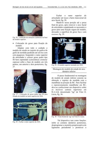 Montagem. de mod. de est. em art. semi-ajustável. Fernandes Neto , A. J. et al. Univ. Fed. Uberlândia - 2005 131
Fig. 26 - confecção de retenções (ranhuras) na base
do modelo superior.
• Colocação do gesso para fixação do
modelo.
Adaptar com todo o cuidado o
modelo de estudo no registro de godiva do
garfo de mordida (podendo até uni-los com
cera pegajosa). Suspender o ramo superior
do articulador e colocar gesso pedra tipo
III bem espatulado (consistência cremosa/
espessa) sobre a base do modelo em três
pontos, um anterior e dois posteriores, fig.
27.
Fig. 27 - Colocação do gesso pedra tipo III para
fixação do modelo ao ramo superior do ASA.
Fig. 28 - Fechar o ramo superior do ASA.
Fechar o ramo superior do
articulador até tocar a barra transversal do
arco facial, fig. 28.
Mantê-lo nessa posição até a presa
final do gesso, após remover o arco facial
do articulador completando se necessário o
gesso para uma fixação segura do modelo,
deixando a superfície de gesso lisa e sem
excesso, fig. 29.
Fig. 29 - O modelo superior montado em ASA.
Montagem do modelo de estudo do arco
dentário inferior
O passo fundamental na montagem
do modelo de estudo inferior consiste na
obtenção e registro da mordida com a
mandíbula na posição de RC. Para facilitar
o reposicionamento mandibular em RC,
deve-se confeccionar um dispositivo sobre
os incisivos centrais superiores em
R.A.A.Q. denominado “jig” de Vítor O.
Lúcia, fig. 30.
Fig. 30 - Vista frontal do “jig” de Vítor O. Lúcia.
Tal dispositivo tem como funções:
inibir os contatos dentários posteriores,
desprogramar a memória proprioceptiva do
ligamento periodontal e promover o
 