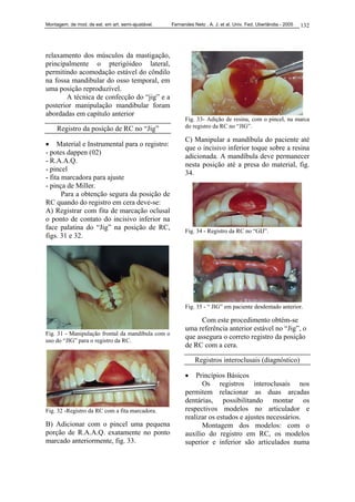Montagem. de mod. de est. em art. semi-ajustável. Fernandes Neto , A. J. et al. Univ. Fed. Uberlândia - 2005 132
relaxamento dos músculos da mastigação,
principalmente o pterigóideo lateral,
permitindo acomodação estável do côndilo
na fossa mandibular do osso temporal, em
uma posição reproduzível.
A técnica de confecção do “jig” e a
posterior manipulação mandibular foram
abordadas em capítulo anterior
Registro da posição de RC no “Jig”
• Material e Instrumental para o registro:
- potes dappen (02)
- R.A.A.Q.
- pincel
- fita marcadora para ajuste
- pinça de Miller.
Para a obtenção segura da posição de
RC quando do registro em cera deve-se:
A) Registrar com fita de marcação oclusal
o ponto de contato do incisivo inferior na
face palatina do “Jig” na posição de RC,
figs. 31 e 32.
Fig. 31 - Manipulação frontal da mandíbula com o
uso do “JIG” para o registro da RC.
Fig. 32 -Registro da RC com a fita marcadora.
B) Adicionar com o pincel uma pequena
porção de R.A.A.Q. exatamente no ponto
marcado anteriormente, fig. 33.
Fig. 33- Adição de resina, com o pincel, na marca
do registro da RC no “JIG”.
C) Manipular a mandíbula do paciente até
que o incisivo inferior toque sobre a resina
adicionada. A mandíbula deve permanecer
nesta posição até a presa do material, fig.
34.
Fig. 34 - Registro da RC no “GIJ”.
Fig. 35 - “ JIG” em paciente desdentado anterior.
Com este procedimento obtém-se
uma referência anterior estável no “Jig”, o
que assegura o correto registro da posição
de RC com a cera.
Registros interoclusais (diagnóstico)
• Princípios Básicos
Os registros interoclusais nos
permitem relacionar as duas arcadas
dentárias, possibilitando montar os
respectivos modelos no articulador e
realizar os estudos e ajustes necessários.
Montagem dos modelos: com o
auxílio do registro em RC, os modelos
superior e inferior são articulados numa
 