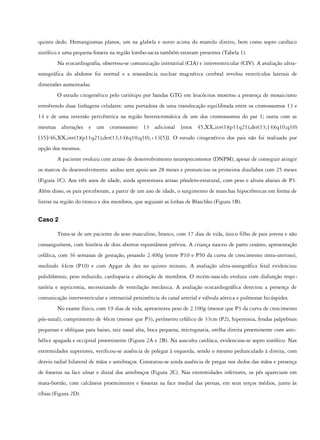 quinto dedo. Hemangiomas planos, um na glabela e outro acima do mamilo direito, bem como sopro cardíaco
sistólico e uma pequena fosseta na região lombo-sacra também estavam presentes (Tabela 1).
Na ecocardiografia, observou-se comunicação interatrial (CIA) e interventricular (CIV). A avaliação ultra-
sonográfica do abdome foi normal e a ressonância nuclear magnética cerebral revelou ventrículos laterais de
dimensões aumentadas.
O estudo citogenético pelo cariótipo por bandas GTG em leucócitos mostrou a presença de mosaicismo
envolvendo duas linhagens celulares: uma portadora de uma translocação equilibrada entre os cromossomos 13 e
14 e de uma inversão pericêntrica na região heterocromática de um dos cromossomos do par 1; outra com as
mesmas alterações e um cromossomo 13 adicional {mos 45,XX,inv(1)(p11q21),der(13;14)(q10;q10)
[35]/46,XX,inv(1)(p11q21),der(13;14)(q10;q10),+13[5]}. O estudo citogenético dos pais não foi realizado por
opção dos mesmos.
A paciente evoluiu com atraso de desenvolvimento neuropsicomotor (DNPM), apesar de conseguir atingir
os marcos do desenvolvimento: andou sem apoio aos 28 meses e pronunciou os primeiros dissílabos com 25 meses
(Figura 1C). Aos três anos de idade, ainda apresentava atraso pôndero-estatural, com peso e altura abaixo de P3.
Além disso, os pais perceberam, a partir de um ano de idade, o surgimento de manchas hipocrômicas em forma de
listras na região do tronco e dos membros, que seguiam as linhas de Blaschko (Figura 1B).
Caso 2
Trata-se de um paciente do sexo masculino, branco, com 17 dias de vida, único filho de pais jovens e não
consanguíneos, com história de dois abortos espontâneos prévios. A criança nasceu de parto cesáreo, apresentação
cefálica, com 36 semanas de gestação, pesando 2.400g (entre P10 e P50 da curva de crescimento intra-uterino),
medindo 44cm (P10) e com Apgar de dez no quinto minuto. A avaliação ultra-sonográfica fetal evidenciou
polidrâmnio, peso reduzido, cardiopatia e alteração de membros. O recém-nascido evoluiu com disfunção respi-
ratória e septicemia, necessitando de ventilação mecânica. A avaliação ecocardiográfica detectou a presença de
comunicação interventricular e interatrial persistência do canal arterial e válvula aórtica e pulmonar bicúspides.
No exame físico, com 19 dias de vida, apresentava peso de 2.100g (menor que P3 da curva de crescimento
pós-natal), comprimento de 46cm (menor que P3), perímetro cefálico de 33cm (P2), hipertonia, fendas palpebrais
pequenas e oblíquas para baixo, raiz nasal alta, boca pequena, micrognatia, orelha direita proeminente com anti-
hélice apagada e occipital proeminente (Figura 2A e 2B). Na ausculta cardíaca, evidenciou-se sopro sistólico. Nas
extremidades superiores, verificou-se ausência de polegar à esquerda, sendo o mesmo pedunculado à direita, com
desvio radial bilateral de mãos e antebraços. Constatou-se ainda ausência de pregas nos dedos das mãos e presença
de fossetas na face ulnar e distal dos antebraços (Figura 2C). Nas extremidades inferiores, os pés apareciam em
mata-borrão, com calcâneos proeminentes e fossetas na face medial das pernas, em seus terços médios, junto às
tíbias (Figura 2D).
 