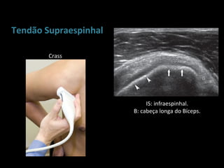 Tendão Supraespinhal

        Crass




                            IS: infraespinhal.
                       B: cabeça longa do Bíceps.
 