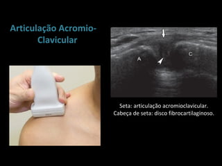 Articulação Acromio-
       Clavicular




                         Seta: articulação acromioclavicular.
                       Cabeça de seta: disco fibrocartilaginoso.
 