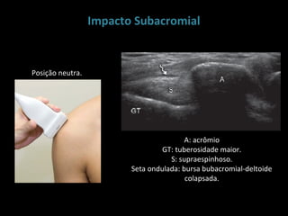 Impacto Subacromial


Posição neutra.




                                         A: acrômio
                                  GT: tuberosidade maior.
                                    S: supraespinhoso.
                         Seta ondulada: bursa bubacromial-deltoide
                                         colapsada.
 
