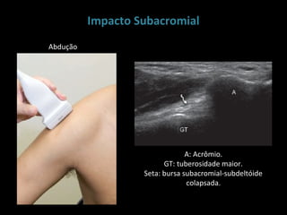 Impacto Subacromial
Abdução




                                A: Acrômio.
                         GT: tuberosidade maior.
                   Seta: bursa subacromial-subdeltóide
                                colapsada.
 