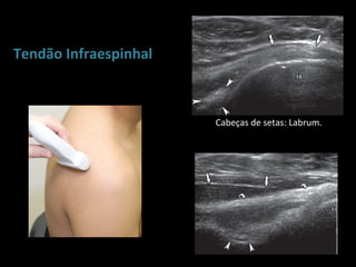 Tendão Infraespinhal



                       Cabeças de setas: Labrum.
 