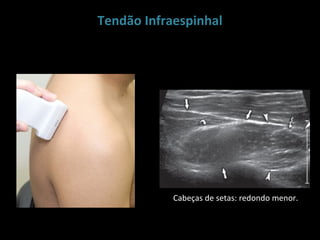 Tendão Infraespinhal




            Cabeças de setas: redondo menor.
 