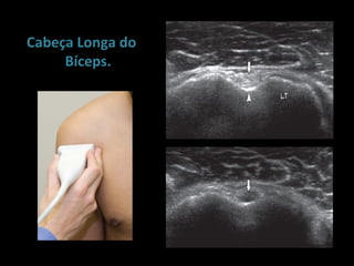 Cabeça Longa do
     Bíceps.
 