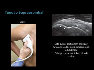 Tendão Supraespinhal

       Crass




                        Seta curva: cartilagem articular.
                       Seta ondulada: bursa subacromial-
                                 subdeltóide.
                        Cabeças de setas: tuberosidade
                                     maior.
 