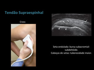 Tendão Supraespinhal

       Crass




                         Seta ondulada: bursa subacromial-
                                   subdeltóide.
                       Cabeças de setas: tuberosidade maior.
 