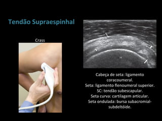 Tendão Supraespinhal

        Crass




                             Cabeça de seta: ligamento
                                     coracoumeral.
                       Seta: ligamento flenoumeral superior.
                               SC: tendão subescapular.
                          Seta curva: cartilagem articular.
                        Seta ondulada: bursa subacromial-
                                      subdeltóide.
 
