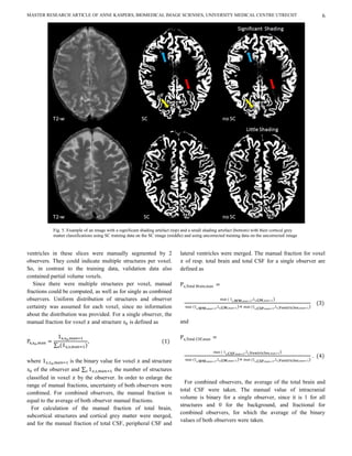MASTER RESEARCH ARTICLE OF ANNE KASPERS, BIOMEDICAL IMAGE SCIENSES, UNIVERSITY MEDICAL CENTRE UTRECHT                                                 6




           Fig. 5. Example of an image with a significant shading artefact (top) and a small shading artefact (bottom) with their cortical grey
           matter classifications using SC training data on the SC image (middle) and using uncorrected training data on the uncorrected image
           (right).

ventricles in these slices were manually segmented by 2                        lateral ventricles were merged. The manual fraction for voxel
observers. They could indicate multiple structures per voxel.                     of resp. total brain and total CSF for a single observer are
So, in contrast to the training data, validation data also                     defined as
contained partial volume voxels.
   Since there were multiple structures per voxel, manual
fractions could be computed, as well as for single as combined
observers. Uniform distribution of structures and observer
certainty was assumed for each voxel, since no information
about the distribution was provided. For a single observer, the
manual fraction for voxel and structure is defined as                          and




                                                                                                                                                  .
where              is the binary value for voxel and structure
   of the observer and                 the number of structures
classified in voxel by the observer. In order to enlarge the
                                                                                 For combined observers, the average of the total brain and
range of manual fractions, uncertainty of both observers were
                                                                               total CSF were taken. The manual value of intracranial
combined. For combined observers, the manual fraction is
                                                                               volume is binary for a single observer, since it is 1 for all
equal to the average of both observer manual fractions.
                                                                               structures and 0 for the background, and fractional for
  For calculation of the manual fraction of total brain,
                                                                               combined observers, for which the average of the binary
subcortical structures and cortical grey matter were merged,
                                                                               values of both observers were taken.
and for the manual fraction of total CSF, peripheral CSF and
 