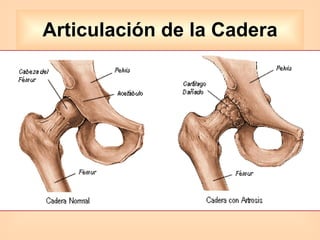 Articulación de la Cadera 