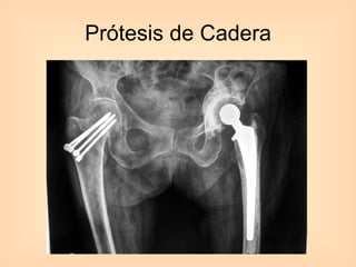 Prótesis de Cadera 