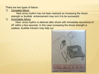 There are two types of failure :
1) Complete failure
Here sinus rhythm has not been restored so increasing the shock
strength or ibutilide enhancement may turn it to be successful
1) Incomplete failure
Here sinus rhythm is attained after shock with immediate recurrence of
AF within a few seconds. In this case increasing the shock strength is
useless, ibutilide infusion may help out
 