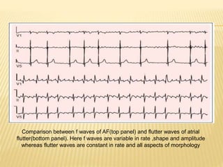 Comparison between f waves of AF(top panel) and flutter waves of atrial
flutter(bottom panel). Here f waves are variable in rate ,shape and amplitude
whereas flutter waves are constant in rate and all aspects of morphology
 