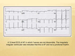 A 12-lead ECG of AF in which f waves are not discernible. The irregularly
irregular ventricular rate indicates that this is AF and not a junctional rhythm.
 