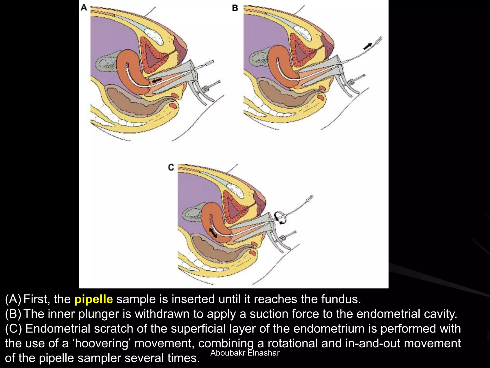 (A) First, the pipelle sample is inserted until it reaches the fundus.
(B) The inner plunger is withdrawn to apply a suction force to the endometrial cavity.
(C) Endometrial scratch of the superficial layer of the endometrium is performed with
the use of a ‘hoovering’ movement, combining a rotational and in-and-out movement
of the pipelle sampler several times.
Aboubakr Elnashar
 