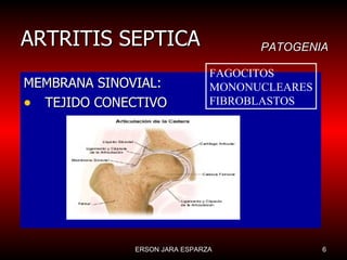 ARTRITIS SEPTICA MEMBRANA SINOVIAL: TEJIDO CONECTIVO FAGOCITOS MONONUCLEARES FIBROBLASTOS PATOGENIA 