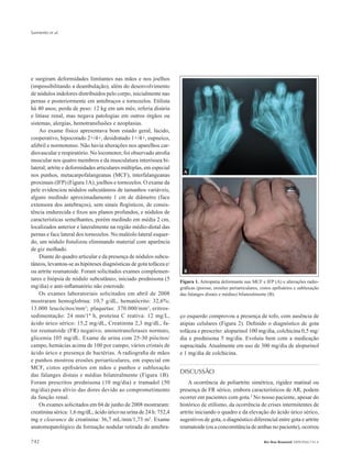 Sarmento et al.
742 Rev Bras Reumatol 2009;49(6):741-6
e surgiram deformidades limitantes nas mãos e nos joelhos
(impossibilitando a deambulação), além do desenvolvimento
de nódulos indolores distribuídos pelo corpo, inicialmente nas
pernas e posteriormente em antebraços e tornozelos. Etilista
há 40 anos; perda de peso: 12 kg em um mês; referia disúria
e litíase renal, mas negava patologias em outros órgãos ou
sistemas, alergias, hemotransfusões e neoplasias.
Ao exame físico apresentava bom estado geral, lúcido,
cooperativo, hipocorado 2+/4+, desidratado 1+/4+, eupneico,
afebril e normotenso. Não havia alterações nos aparelhos car-
diovascular e respiratório. No locomotor, foi observado atrofia
muscular nos quatro membros e da musculatura interóssea bi-
lateral; artrite e deformidades articulares múltiplas, em especial
nos punhos, metacarpofalangeanas (MCF), interfalangeanas
proximais (IFP) (Figura 1A), joelhos e tornozelos. O exame da
pele evidenciou nódulos subcutâneos de tamanhos variáveis,
alguns medindo aproximadamente 1 cm de diâmetro (face
extensora dos antebraços), sem sinais flogísticos, de consis-
tência endurecida e fixos aos planos profundos, e nódulos de
características semelhantes, porém medindo em média 2 cm,
localizados anterior e lateralmente na região médio-distal das
pernas e face lateral dos tornozelos. No maléolo lateral esquer-
do, um nódulo fistulizou eliminando material com aparência
de giz molhado.
Diante do quadro articular e da presença de nódulos subcu-
tâneos, levantou-se as hipóteses diagnósticas de gota tofácea e/
ou artrite reumatoide. Foram solicitados exames complemen-
tares e biópsia de nódulo subcutâneo; iniciado prednisona (5
mg/dia) e anti-inflamatório não esteroide.
Os exames laboratoriais solicitados em abril de 2008
mostraram hemoglobina: 10,7 g/dL, hematócrito: 32,6%;
13.000 leucócitos/mm3
; plaquetas: 370.000/mm3
, eritros-
sedimentação: 24 mm/1ª h, proteína C reativa: 12 mg/L,
ácido úrico sérico: 15,2 mg/dL, Creatinina 2,3 mg/dL, fa-
tor reumatoide (FR) negativo, aminotransferases normais,
glicemia 105 mg/dL. Exame de urina com 25-30 piócitos/
campo, hemácias acima de 100 por campo, vários cristais de
ácido úrico e presença de bactérias. A radiografia de mãos
e punhos mostrou erosões periarticulares, em especial em
MCF, cistos epifisários em mãos e punhos e subluxação
das falanges distais e médias bilateralmente (Figura 1B).
Foram prescritos prednisona (10 mg/dia) e tramadol (50
mg/dia) para alívio das dores devido ao comprometimento
da função renal.
Os exames solicitados em 04 de junho de 2008 mostraram:
creatinina sérica: 1,6 mg/dL; ácido úrico na urina de 24 h: 752,4
mg e clearance de creatinina: 36,7 mL/min/1,73 m2
. Exame
anatomopatológico da formação nodular retirada do antebra-
ço esquerdo comprovou a presença de tofo, com ausência de
atipias celulares (Figura 2). Definido o diagnóstico de gota
tofácea e prescrito: alopurinol 100 mg/dia, colchicina 0,5 mg/
dia e prednisona 5 mg/dia. Evoluiu bem com a medicação
supracitada. Atualmente em uso de 300 mg/dia de alopurinol
e 1 mg/dia de colchicina.
DISCUSSÃO
A ocorrência de poliartrite simétrica, rigidez matinal ou
presença de FR sérico, embora característicos de AR, podem
ocorrer em pacientes com gota.2
No nosso paciente, apesar do
histórico de etilismo, da ocorrência de crises intermitentes de
artrite iniciando o quadro e da elevação do ácido úrico sérico,
sugestivos de gota, o diagnóstico diferencial entre gota e artrite
reumatoide (ou a concomitância de ambas no paciente), ocorreu
Figura 1. Artropatia deformante nas MCF e IFP (A) e alterações radio-
gráficas (porose, erosões periarticulares, cistos epifisários e subluxação
das falanges distais e médias) bilateralmente (B).
A
B
 