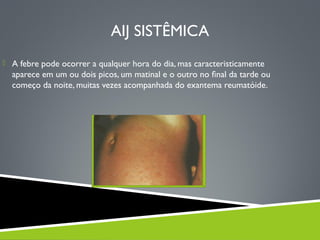 AIJ SISTÊMICA
 A febre pode ocorrer a qualquer hora do dia, mas caracteristicamente

aparece em um ou dois picos, um matinal e o outro no ﬁnal da tarde ou
começo da noite, muitas vezes acompanhada do exantema reumatóide.

 