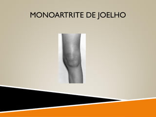 MONOARTRITE DE JOELHO
 