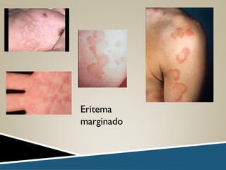 Eritema
marginado
 