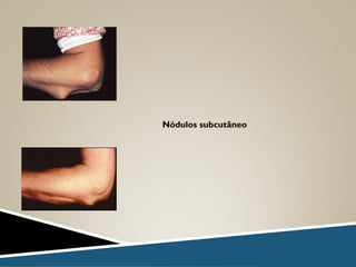 Nódulos subcutâneo
 
