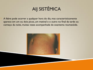 AIJ SISTÊMICA
 A febre pode ocorrer a qualquer hora do dia, mas caracteristicamente
aparece em um ou dois picos, um matinal e o outro no ﬁnal da tarde ou
começo da noite, muitas vezes acompanhada do exantema reumatóide.
 