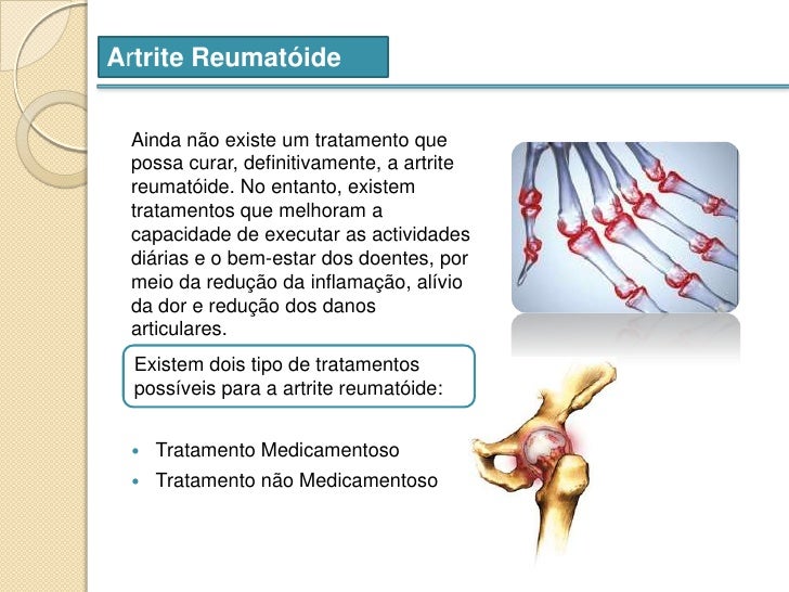 tratamentul ocular al artritei reumatoide tratamentul ocular al artritei reumatoide