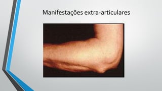 Manifestações extra-articulares
 