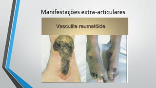 Manifestações extra-articulares
 