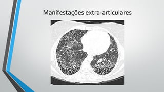 Manifestações extra-articulares
 