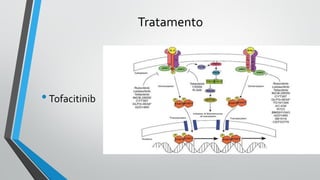 Tratamento
•Tofacitinib
 