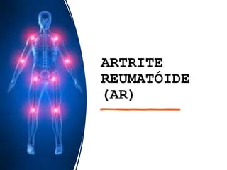 ARTRITE
REUMATÓIDE
(AR)
 