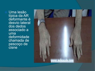 Uma lesão típica da AR deformante é desvio lateral dos dedos associado a uma deformidade chamada de pescoço de cisne