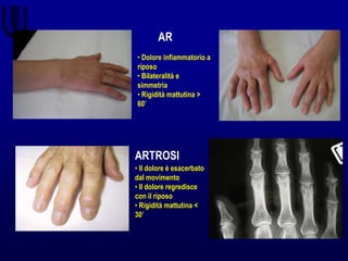 AR
ARTROSI
• Il dolore è esacerbato
dal movimento
• Il dolore regredisce
con il riposo
• Rigidità mattutina <
30’
• Dolore infiammatorio a
riposo
• Bilateralità e
simmetria
• Rigidità mattutina >
60’
 