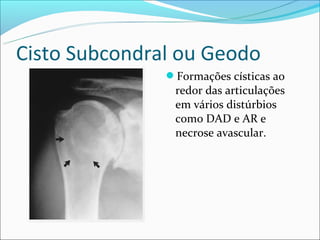 Cisto Subcondral ou Geodo
               Formações císticas ao
                redor das articulações
                em vários distúrbios
                como DAD e AR e
                necrose avascular.
 