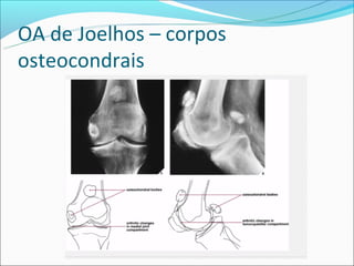 OA de Joelhos – corpos
osteocondrais
 