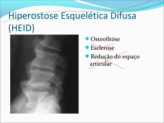 Hiperostose Esquelética Difusa
(HEID)
                 Osteofitóse
                 Esclerose
                 Redução do espaço
                   articular
 
