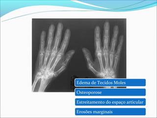 Edema de Tecidos Moles

Osteoporose

Estreitamento do espaço articular

Erosões marginais
 
