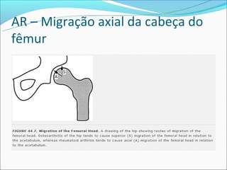 AR – Migração axial da cabeça do
fêmur
 