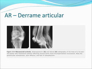 AR – Derrame articular
 
