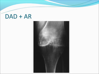 DAD + AR
 