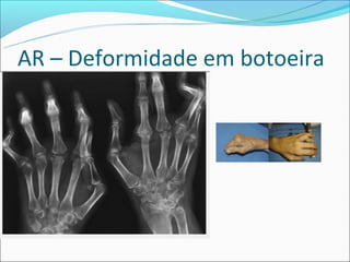 AR – Deformidade em botoeira
 