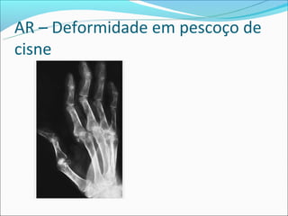 AR – Deformidade em pescoço de
cisne
 